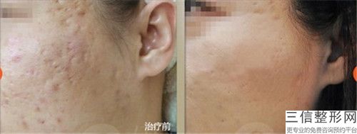 荊州雅美津匯美容診所整形收費標準項目情況一覽-大腿根疤手術案例