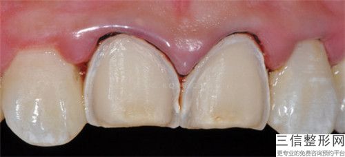 蘭州夢想整形美容醫院牙縫修補整形手術的效果究竟怎么樣