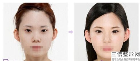 杭州眼皮提肌會不會有害「杭州眼皮提肌美容術(shù)有沒有年齡限制」