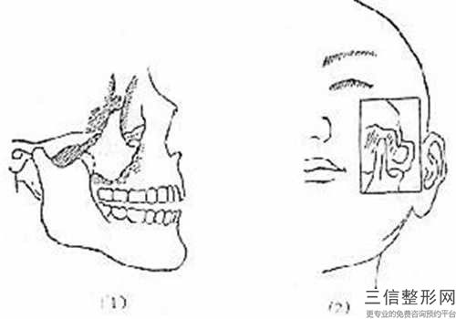 國內(nèi)縮顴骨醫(yī)院推薦：縮顴骨醫(yī)院前50口碑醫(yī)