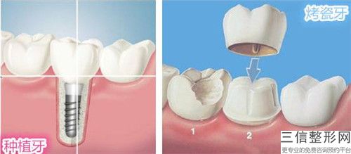 深圳太美醫療門診部emax全瓷牙失敗修復手術的效果好嗎