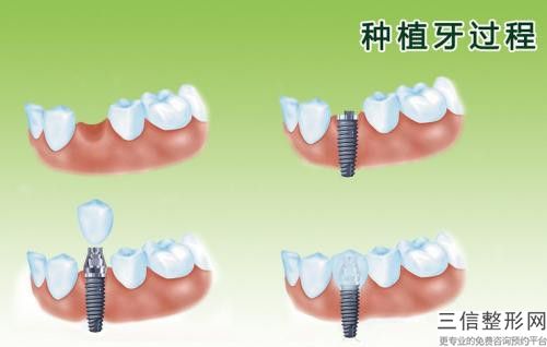 肖征剛舌側(cè)全隱形牙齒矯正整形的并發(fā)癥及效果