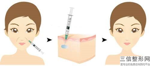 葫蘆島激光磨削除皺術(shù)矯正的治療方法與效果