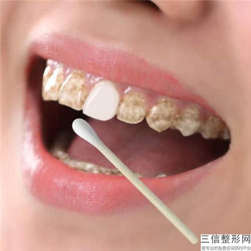 董泗洋牙齒美容烤瓷牙會產(chǎn)生哪些副作用和危害