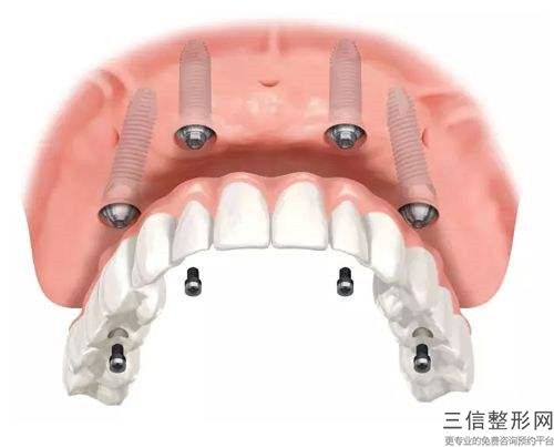 邢臺正畸牽引牙冠延長術(shù)會影響出汗功能嗎