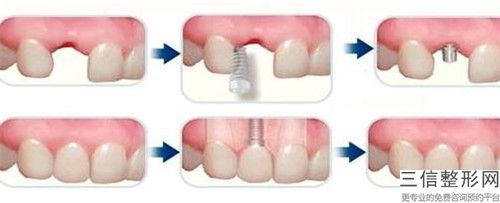 樁冠烤瓷牙整形手術的效果究竟如何