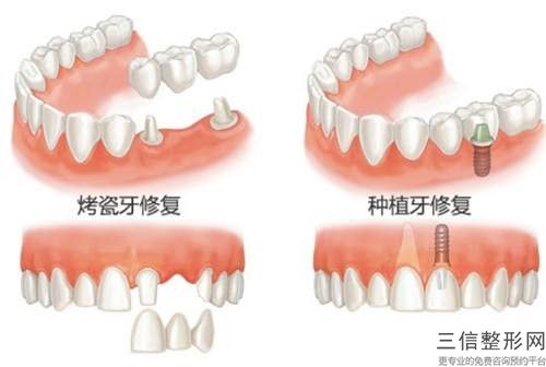 新鄉全冠修復牙齒怎樣做才能降低風險