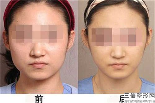 磨臉頰骨醫院推薦：磨臉頰骨醫院前30位細數如何