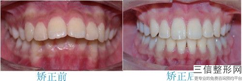 徐州種植牙修復牙縫寬大整形有著什么樣的效果