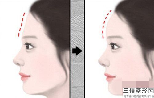 睢陽時光醫療美容診所價格(價目)表查詢_醫生推薦-下額骨磨骨案例