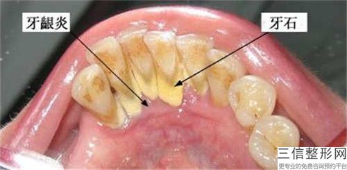 哈爾濱齙牙矯正手術(shù)術(shù)后效果是否自然