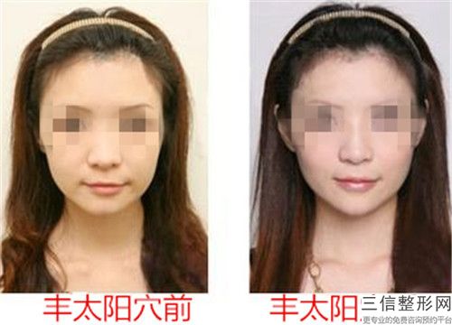 孝感漢川麗萊醫療美容門診部價格價位表2024優惠提前預知-自體脂肪移植豐太陽穴手術案例