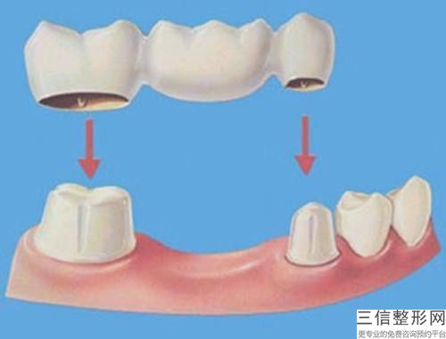 重慶3d氧化鈷全瓷牙手術(shù)需要準備多少錢