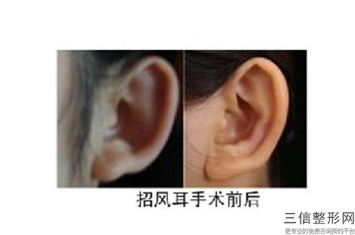 中國人體外耳再造醫(yī)院推薦：人體外耳再造醫(yī)院前50更新大盤點