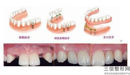 國內露牙齦正畸醫(yī)院推薦：露牙齦正畸醫(yī)院50強為您誠摯推薦