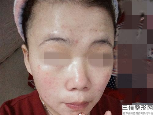 武威亞美美容整形外科整形費用表明細口碑一覽-激光治療點痣疤痕案例