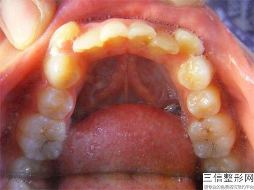 珠海口外弓推磨牙整形手術適合的5類人群