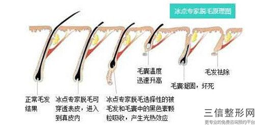 錫林郭勒毛發移植治療脫發整形究竟有沒有副作用