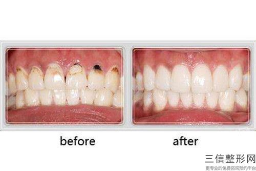 呼倫貝爾以色列丹特因dentin種植牙哪種方法比較安全