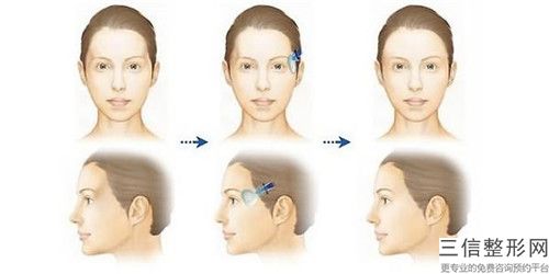 石家莊友愛醫院燒傷整形診療中心整形價格價位表詳情表一覽-硅膠假體豐太陽穴案例
