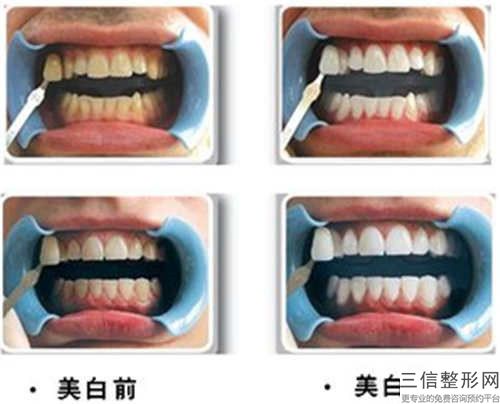 全瓷牙固定橋能管多久時間