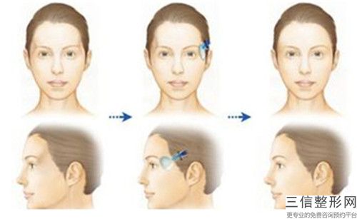 長春吉美醫學美容面部注射豐太陽穴的安全方法