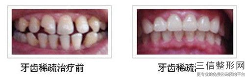 周口烤塑牙冠整形術(shù)的價(jià)格是多少