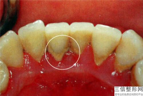 榆林短牙齒矯正手術(shù)后出現(xiàn)后遺癥怎么處理