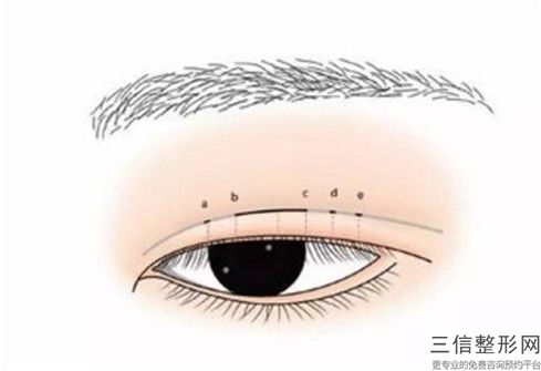 秦皇島市fotona4d眼周醫生哪位規模比較大-張一凡整形醫生技術不錯