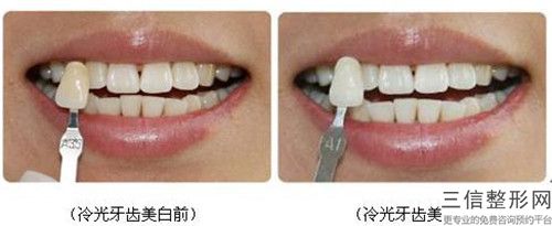 安陽Hi-teeth牙齒美白術一般能維持多久時間