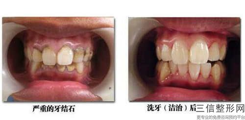 前牙美學(xué)一般持續(xù)多久