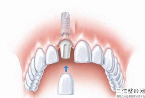 本溪種植牙固定手術方法比較安全