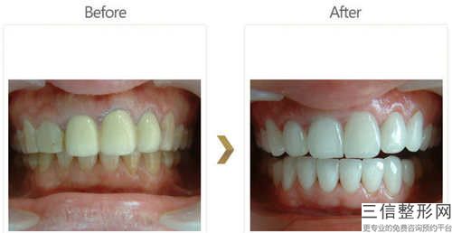 赤峰樹脂粘接全瓷牙整形手術都有后遺癥嗎