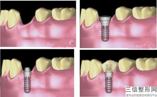 欽州前牙種植義齒整形術(shù)前準(zhǔn)備和術(shù)后護理