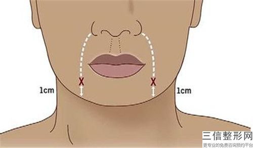 本溪王小明醫(yī)療美容整形診所生物素除皺價(jià)格大概多少