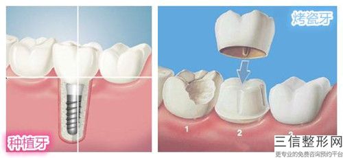 資陽半口拓美種植牙手術的效果特點