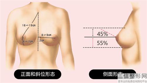 做曼桃假體豐胸能達到什么效果 