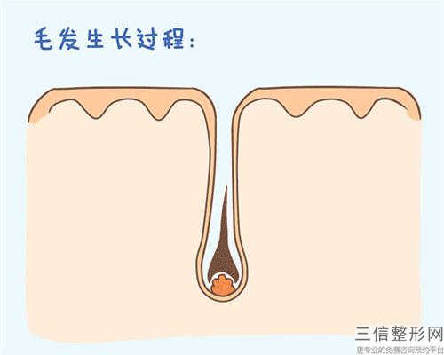 植發(fā)功效說明_不同手術(shù)者移植毛發(fā)功效為何有區(qū)別