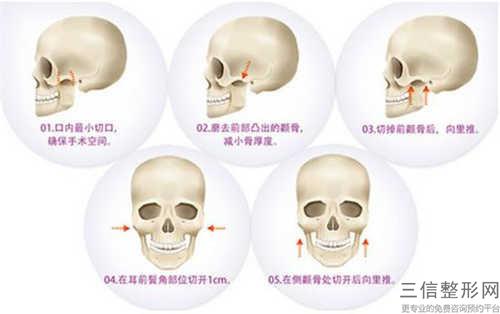 適合下頜角整形術的妹子有幾種