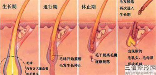 局部激光脫毛術的原理和安全指數怎樣