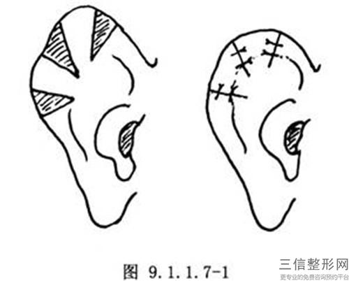 付耳消除手術的花費貴不貴