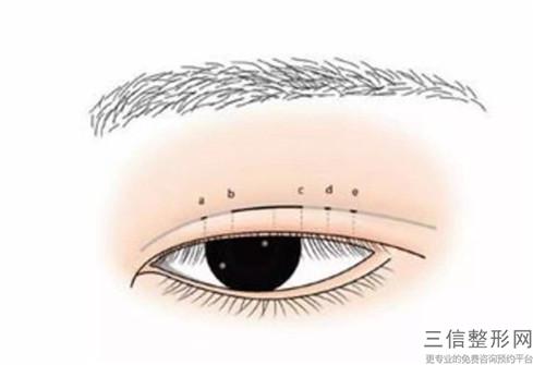 內眥開大術和外眥開大整形術分別花多少錢