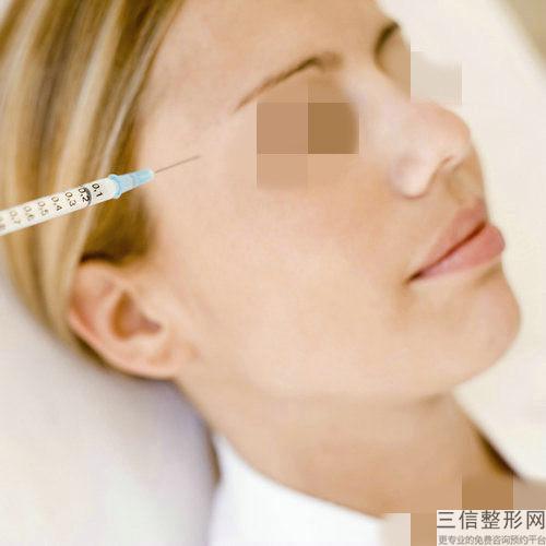 打保妥適（botox）去鼻唇溝（法令紋）多少錢？成效好嗎？