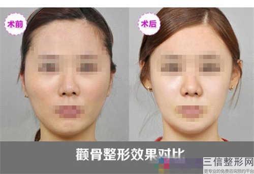 這文章女士們?cè)趯?shí)行頜骨整容完成以前必須要看看