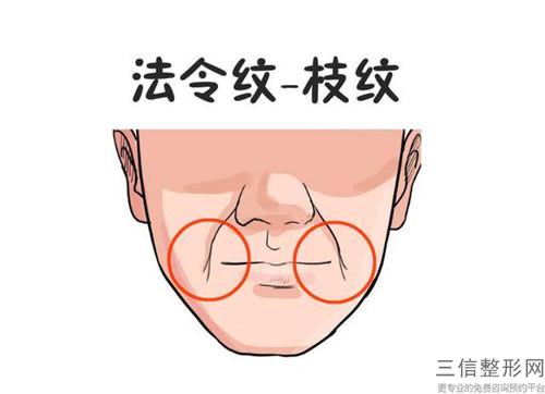 4大極大可能出現的快速消除法令紋的副作用